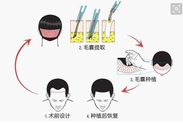 發(fā)際線為什么會(huì)后移,發(fā)際線后移該怎么辦